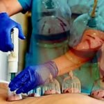 Curso completo de Hijama Terapeutica :
