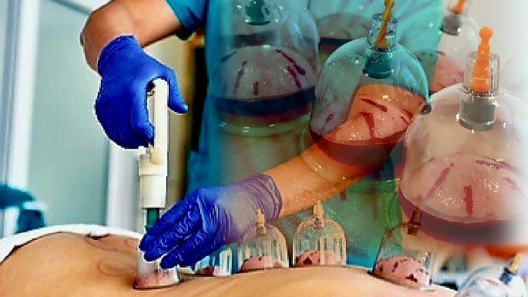 Curso completo de Hijama Terapeutica :