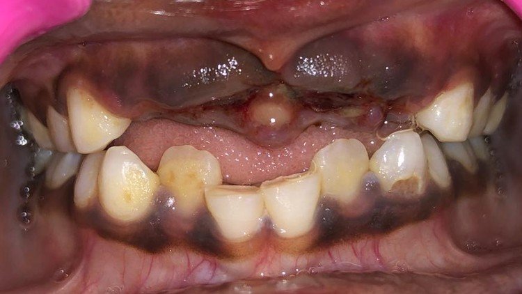 Dental Avulsion: Emergency Management and Clinical Care